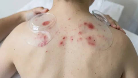 Masaż Bańką Chińską Plecy